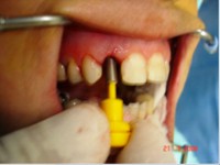 /album/galeria-de-fotos-carga-imediata-apos-exodontia-atraumatica-/carga-imediata-com-exodontia-atraumatica5-jpg/